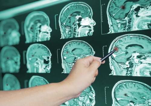 How long does a tbi lawsuit take?